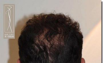 Hair restoration procedure results