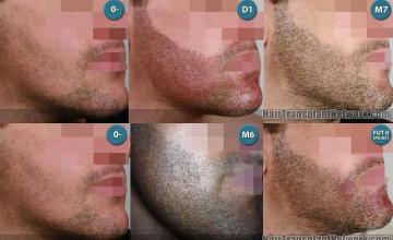 Beard transplantation surgery before and after images