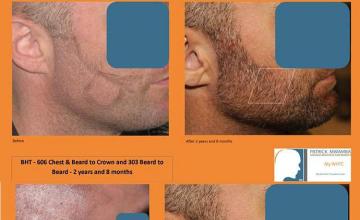 Beard restoration procedure before and after results