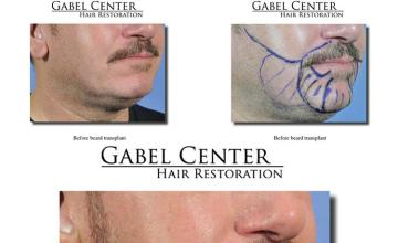 Hair transplantation surgery before and after photos