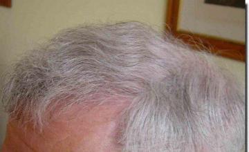 Hair restoration procedure results