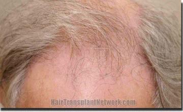 Hair restoration procedure results