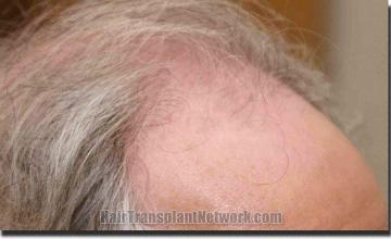 Hair restoration procedure results