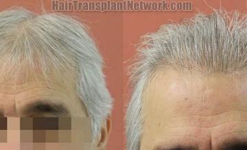 Hair restoration procedure before and after results