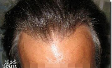 Hair restoration procedure results