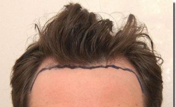 Hair restoration procedure results