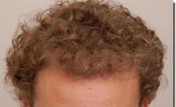 Hair restoration procedure results