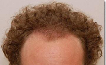 Hair restoration procedure results