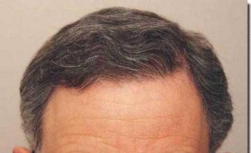 Hair restoration procedure results