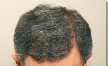 Hair restoration procedure results