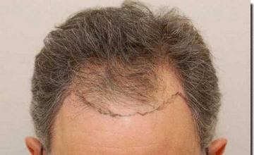 Hair restoration procedure results