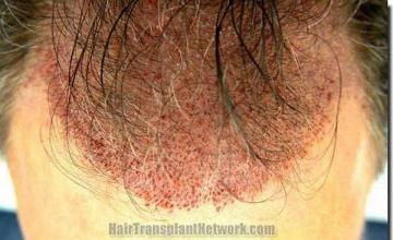 Hair restoration procedure results