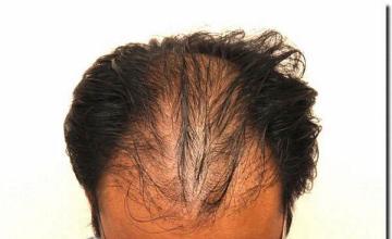 Hair restoration procedure results