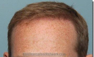 Hair restoration procedure results