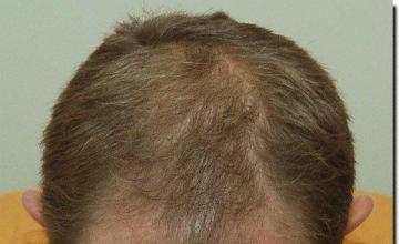 Hair restoration procedure results