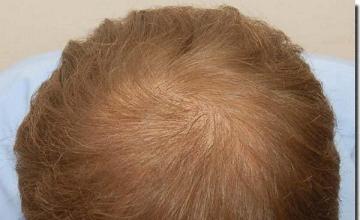 Hair restoration procedure results