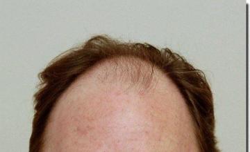 Hair restoration procedure results