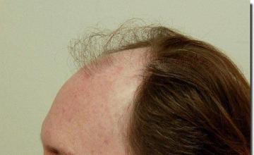 Hair restoration procedure results