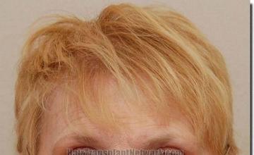 Hair restoration procedure results