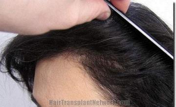 Hair restoration procedure results