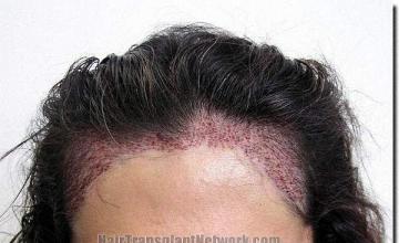 Hair restoration procedure results