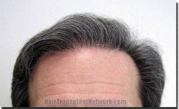 Hair restoration procedure results