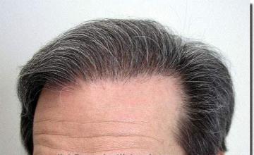 Hair restoration procedure results