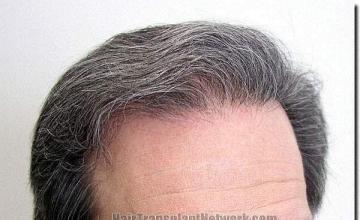 Hair restoration procedure results