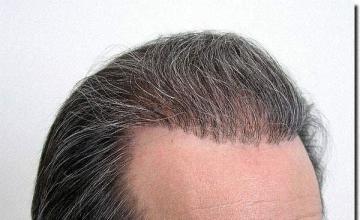 Hair restoration procedure results