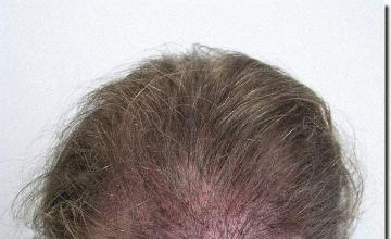 Hair restoration procedure results