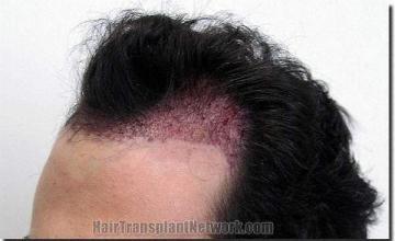 Hair restoration procedure results