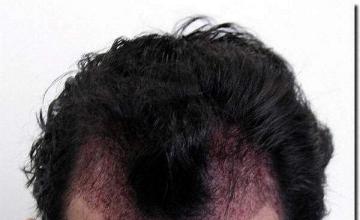 Hair restoration procedure results