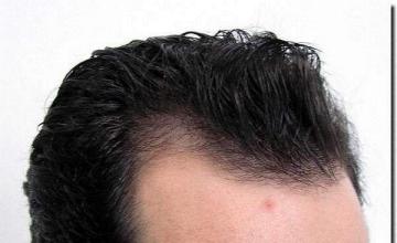 Hair restoration procedure results