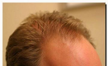 Hair restoration procedure results