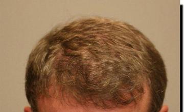 Hair restoration procedure results