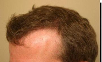 Hair restoration procedure results