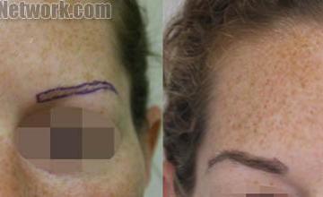 Eyebrow restoration procedure before and after results