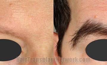 Left view - Eyebrow transplant surgery before and after photos