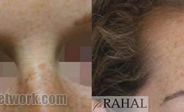 Eyebrow transplantation surgery before and after photos