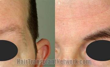 Eyebrow transplantation procedure before and after results