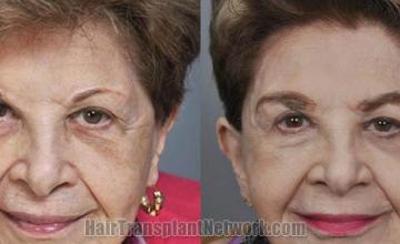 Hair restoration procedure before and after results