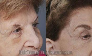 Hair transplantation surgery before and after photos