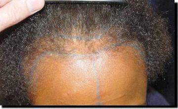 Hair restoration procedure results