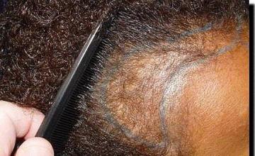 Hair restoration procedure results