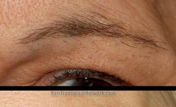 Eyebrow hair restoration procedure before and after