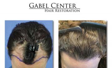 Hair transplantation surgery before and after pictures