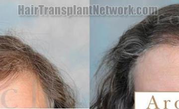 Female hair restoration procedure before and after