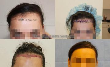 Hair restoration procedure before and after results