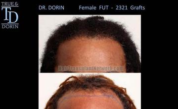 Hair restoration procedure before and after results