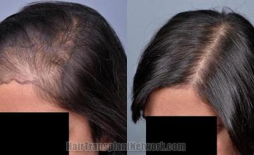 Hair restoration procedure before and after pictures